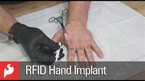 rfid chip in hand 2019|rfid implants before and after.